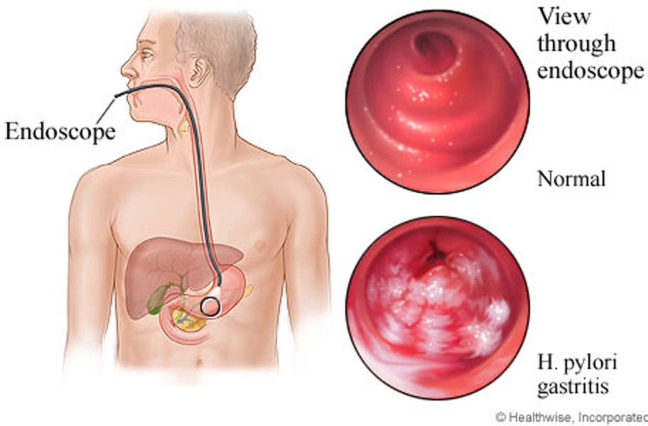 Nhiễm khuẩn. Helicobacter pylori hay còn gọi là H. pylori được xem là nguyên nhân hàng đầu gây viêm bệnh. Vi khuẩn này thường xuất hiện ở niêm mạc dạ dày và phần đầu của ruột non. Nhiễm H. pylori phổ biến ở các nước đang phát triển và ảnh hưởng khoảng một nửa dân số thế giới. Thông thường, nhiễm H.pylori không có triệu chứng đặc hiệu song một số trường hợp có thể dẫn đến đau dạ dày, loét và ung thư dạ dày.